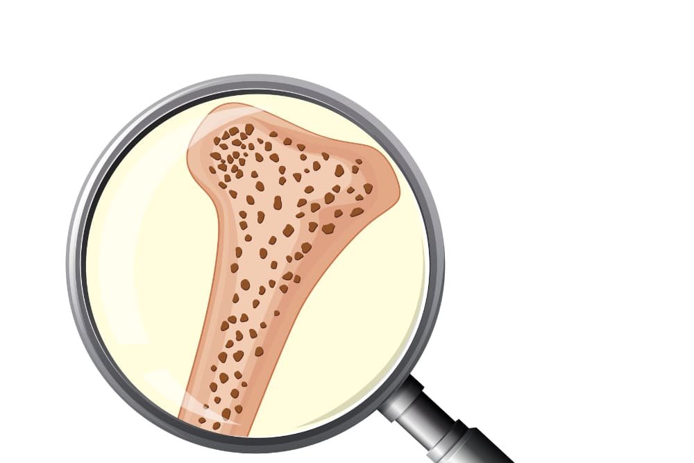 Evaluación y manejo de osteoporosis